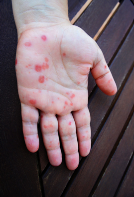 Milyen betegségre utalnak a vörös foltok? - HáziPatika Vörös foltok a kezeken éget mi ez